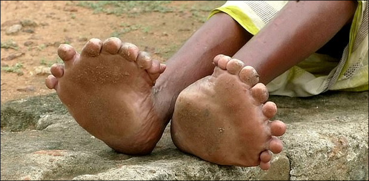 Woman with 19 TOES
