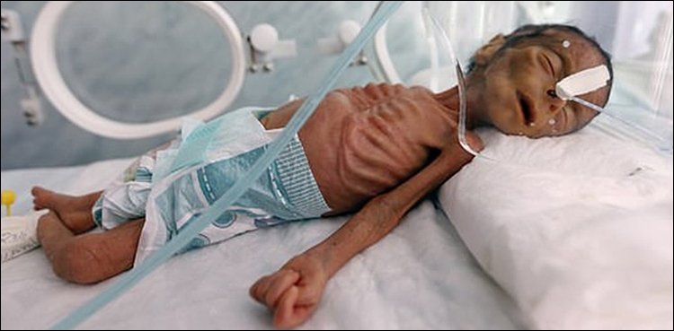 malnourished baby