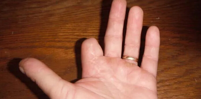 شوہر نے بیوی کی انگلی دانتوں سے کاٹ کر الگ کر دی