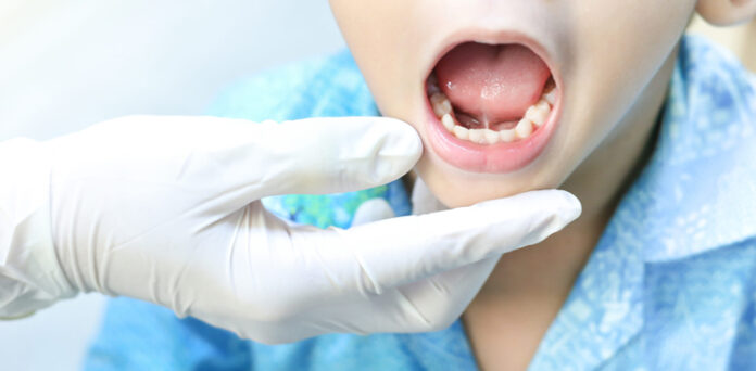 ڈاکٹر نے غلطی سے کمسن بچی کی انگلی کے بجائے زبان کاٹ دی