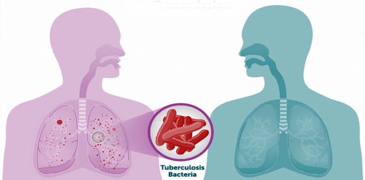 وہ انفیکشن جو برسوں تک چھپا رہ کر جسم پر اچانک حملہ کرتا ہے
