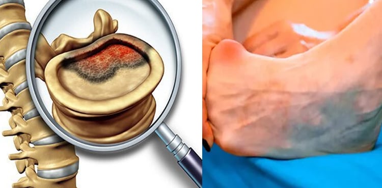 ہڈیوں کا درد معمولی نہیں، نظر انداز کیا تو ۔ ۔ ۔ ۔ ۔ ۔! خطرناک مرض‌ کی علامت