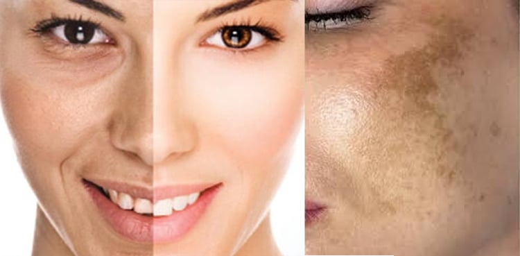 چہرے کی چھائیاں کیسے دور کی جائیں؟ ایک چیز بھول کر بھی استعمال نہ کریں