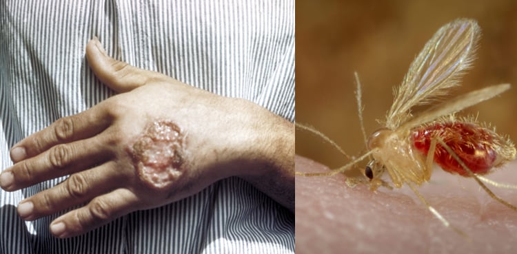 لیشمینیا : کیا ایک مکھی کے کاٹنے سے بڑا زخم بن سکتا ہے؟