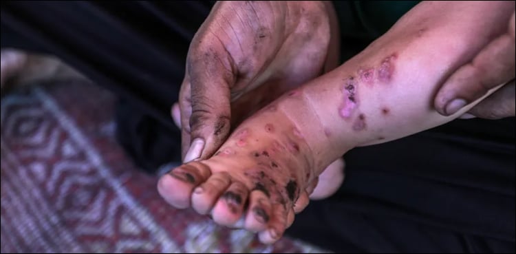 غزہ میں کیڑے مکوڑوں اور چوہوں سے جلدی بیماریاں تیزی سے پھیلنے لگیں
